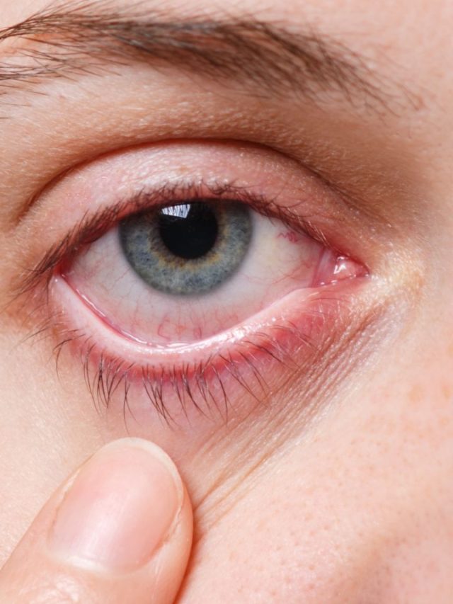 6 Natural Eye Flu Treatments To Get Rid Off.